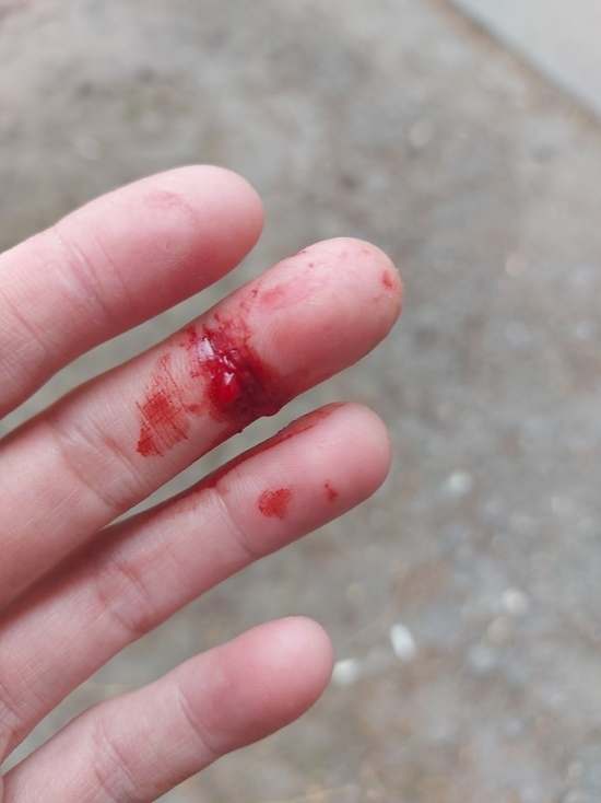 Девушка из Воронежа пожаловалась на прохожую, которая прокусила ей руку и пыталась брызнуть в лицо из баллончика