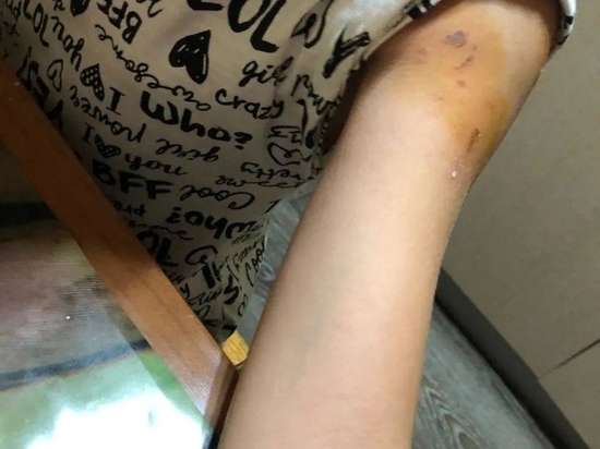 В Сочи на несовершеннолетнюю девочку напала бездомная собака