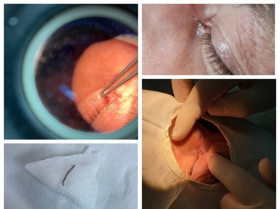 В Чувашии офтальмологи спасли мужчине глаз, пострадавший от скобы