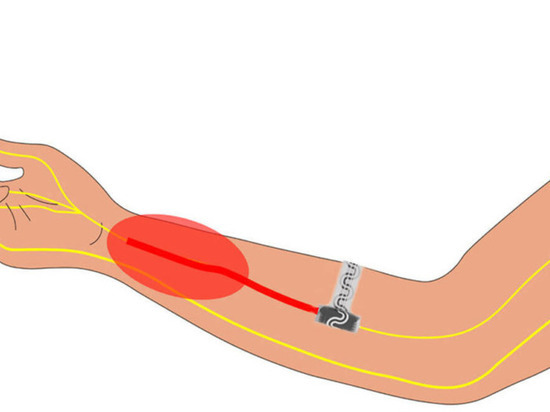 Ученые создали имплант для блокировки боли без лекарств