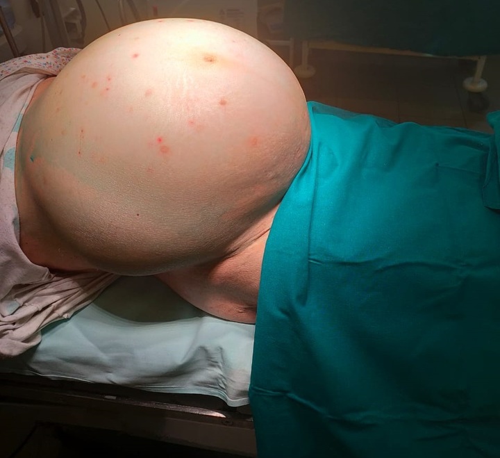 Пенсионерка более пяти лет проходила с 15-килограммовой опухолью матки