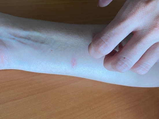 Дерматовенеролог Анчикова рассказала, как выявить ВИЧ по пятнам на коже