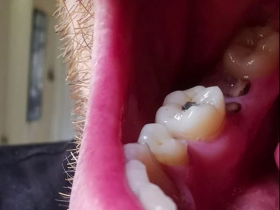 Британка не дождалась приема у стоматолога и самостоятельно вырвала себе половину зубов