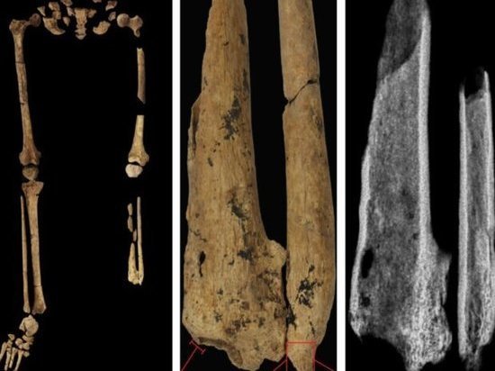 Древний скелет без ноги изменил представление об истории человечества