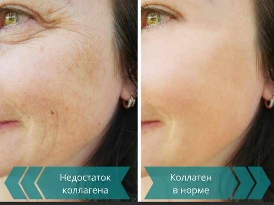 Врач-ревматолог рассказала, чем грозит снижение уровня коллагена в организме