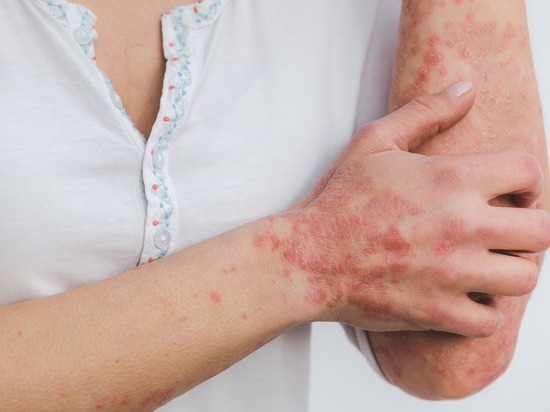 Названы болезни кожи, из-за которых могут дать отсрочку от частичной мобилизации