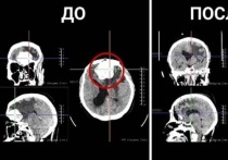 Сотрудники Республиканской клинической больницы имени Н.А. Семашко в Бурятии спасли 60-летнюю женщину со сложной опухолью головного мозга