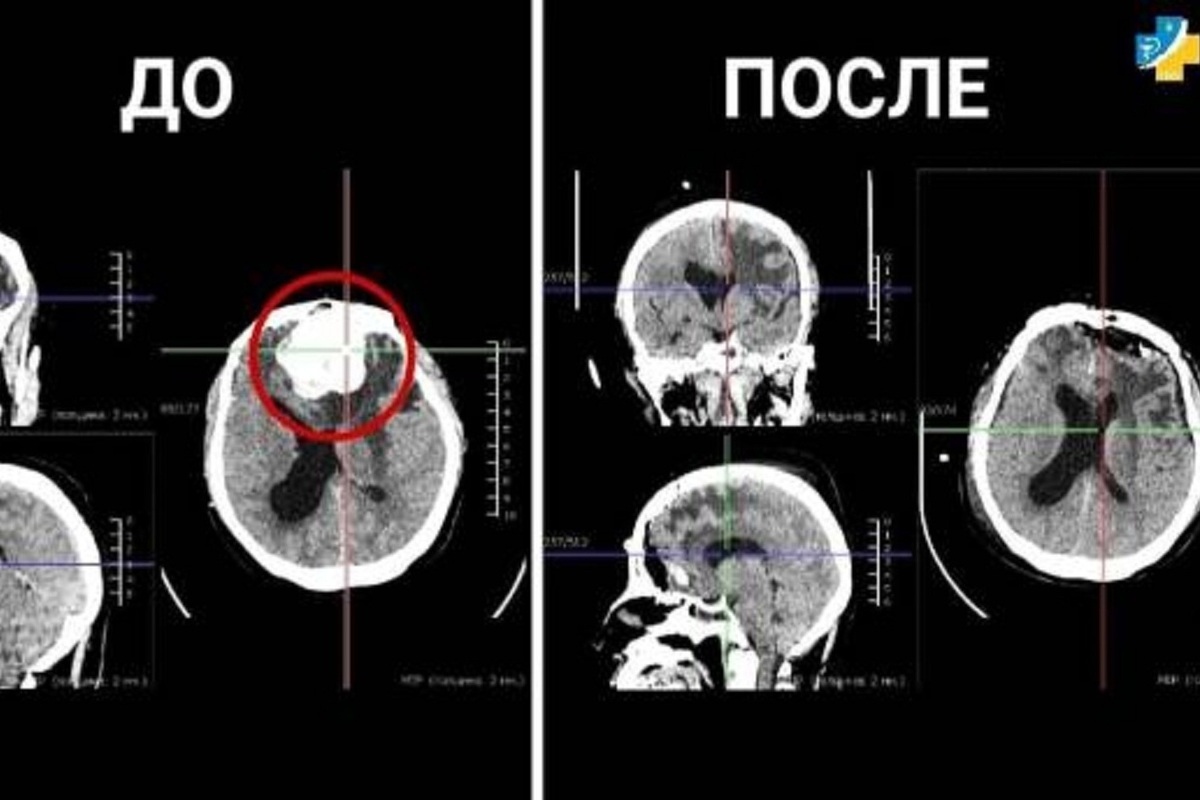 Объемное образование головного мозга код. Снимки головного мозга. Объемное образование головного мозга.