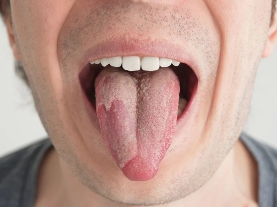 Врач-онколог назвал неочевидные признаки рака языка