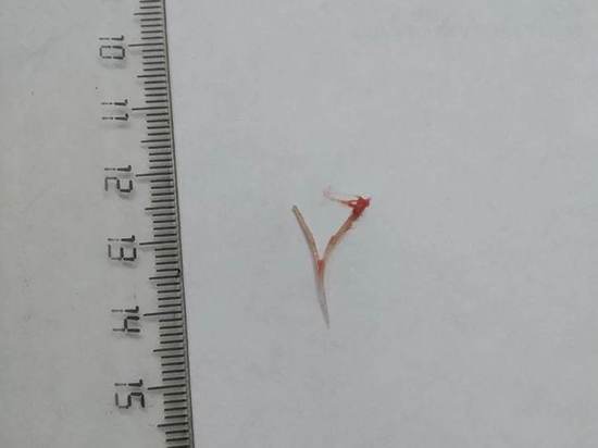 Ступинские врачи спасли мужчину, который подавился костью