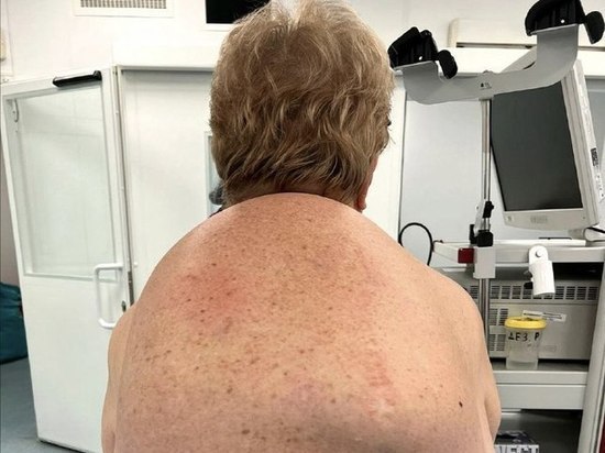 Гигантский жировик со спины женщины удалили врачи Долгопрудного
