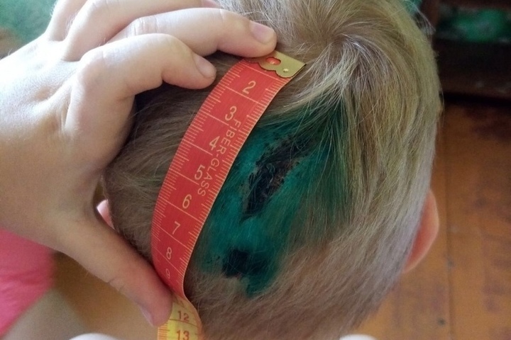 Ярославский суд назначил минимальную компенсацию за пробитую голову малолетнего ребенка
