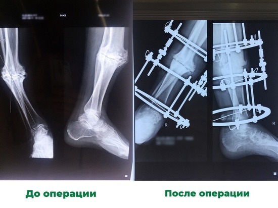 Ставропольцу восстановили ногу спустя 50 лет после ДТП