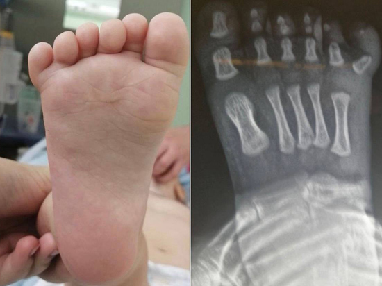 Подмосковные хирурги рассказали про удаление малышу шестого пальца