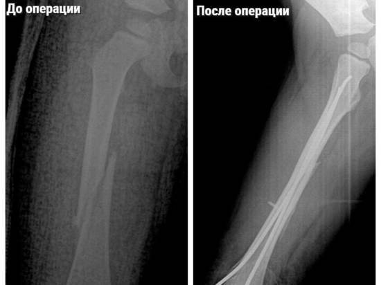 Врачи Подмосковья помогли двухлетнему малышу, который сломал ногу на батуте