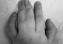 Разделить пальчики на одной из кистей годовалого малыша, родившегося с редкой патологией, пришлось медикам Московской областной детской клинической травматолого-ортопедической больницы