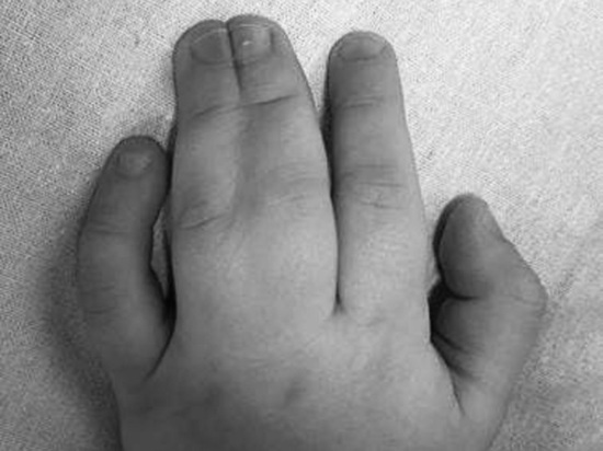 Подмосковные врачи прооперировали годовалого малыша со срощенными пальцами