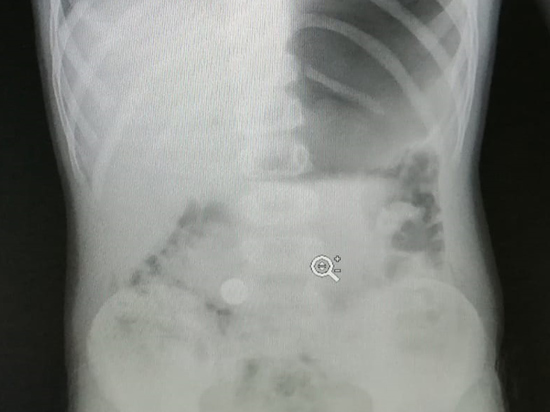 В Балашихе ребенок проглотил металлический шарик: деталь увидели на рентгене