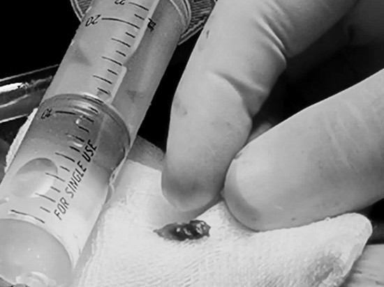 Осколок снаряда достали врачи госпиталя Вишневского из сердца военного