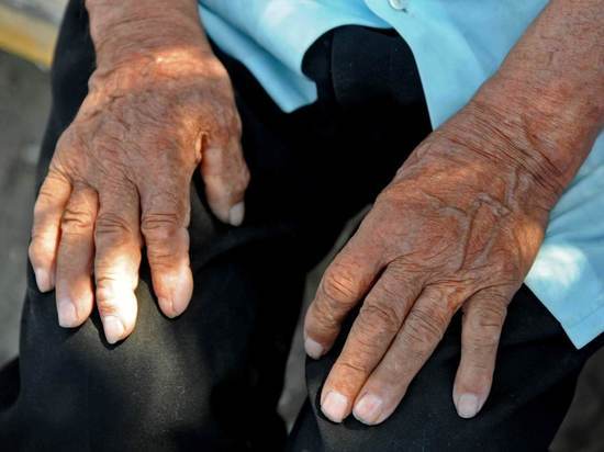 Онколог назвал небольшой признак рака легких, который можно увидеть на руке