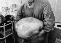 Настойками из укропа и растительным маслом на протяжении нескольких лет лечила свой мнимый метеоризм 62-летняя жительница Подольска, пока не оказалось, что внутри себя она носит гигантскую опухоль весом