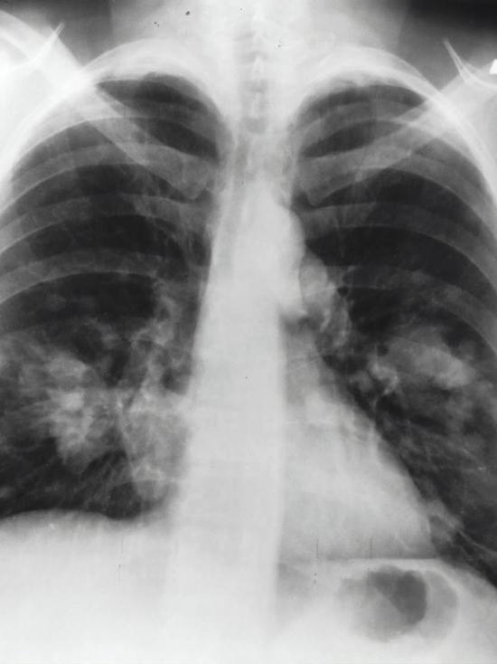 В Бурятии наблюдается неблагополучная ситуация по туберкулезу