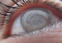 В конце марта проходит Всемирная неделя борьбы с глаукомой — заболеванием, которое врачи называют тихим вором зрения