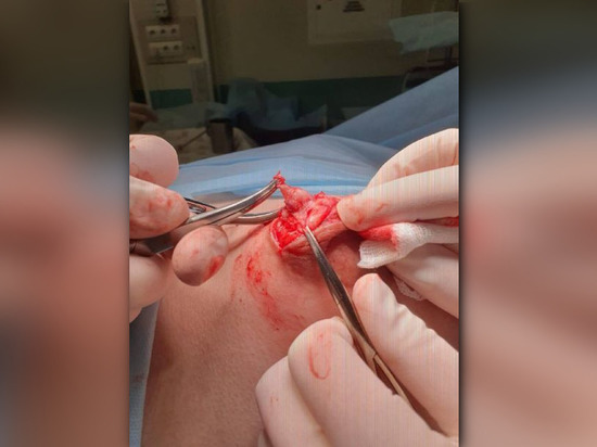 Уфимские врачи удалили юной пациентке внутрипротоковую папиллому молочной железы