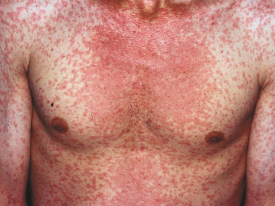 Болезнь начинается с 40-градусной температуры