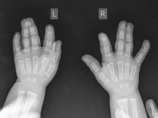 Малышу в центре Илизарова в Кургане разделили сросшиеся пальчики