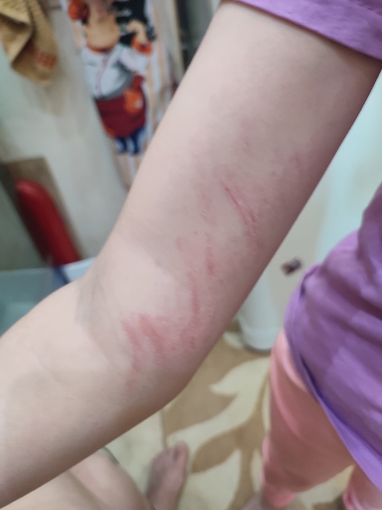 «Ободрала руки»: в парке Ноябрьска девочка упала в закрытом на ремонт веревочном городке