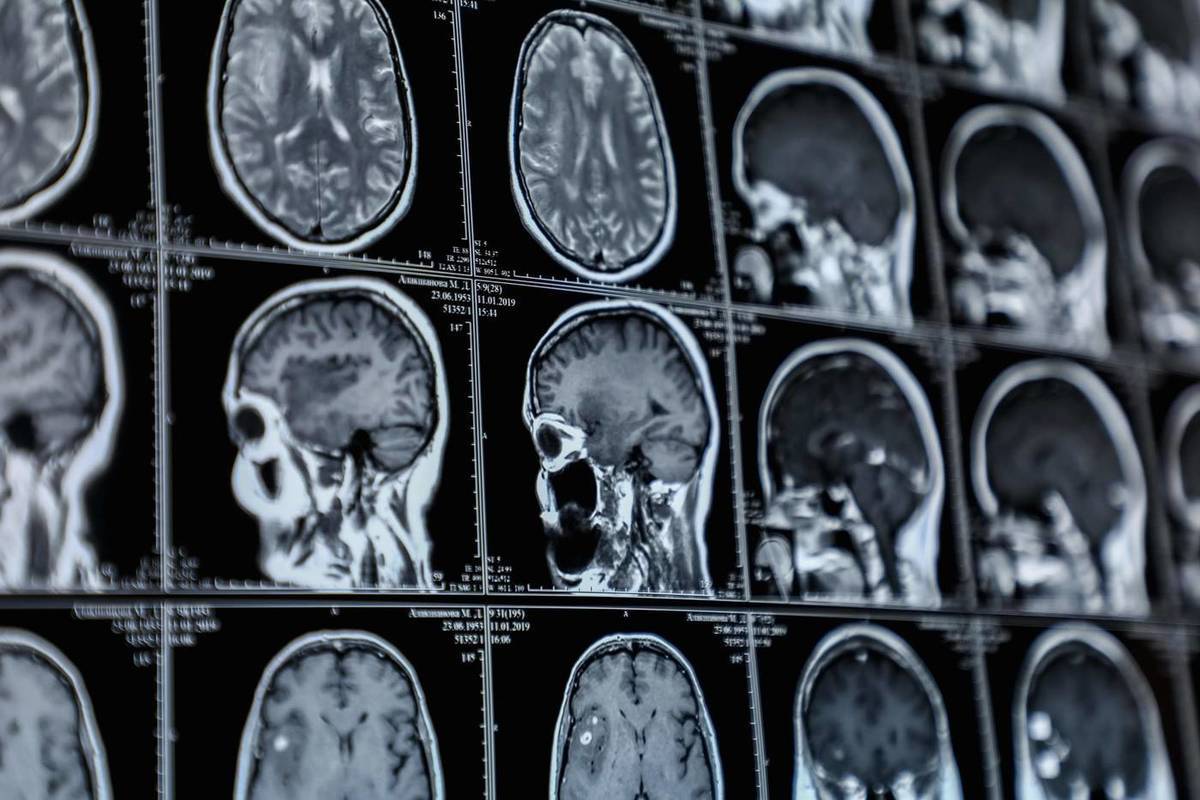 У упавшего с самоката 20-летнего волгоградца врачи обнаружили опухоль мозга