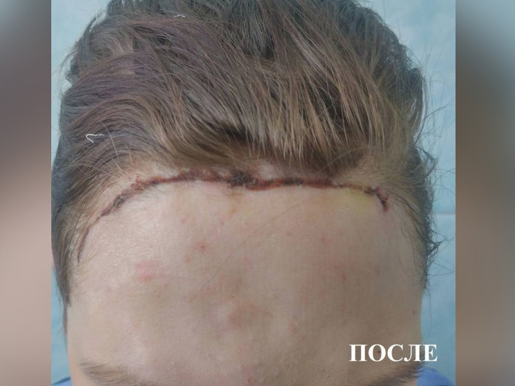 Врачи Башкирии прооперировали девушку, жившую три года с дырой во лбу