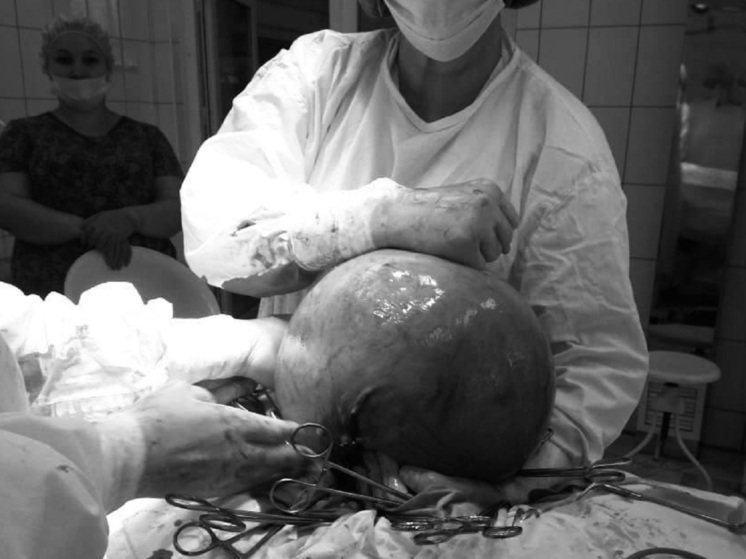 Алтайские врачи удалили пациентке кисту размером с футбольный мяч