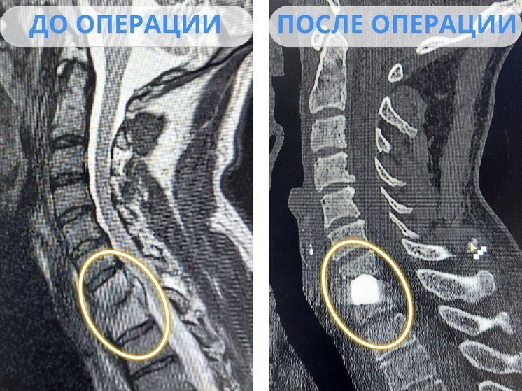 В Новом Уренгое мужчине поставили уникальный имплантат и спасли от инвалидности