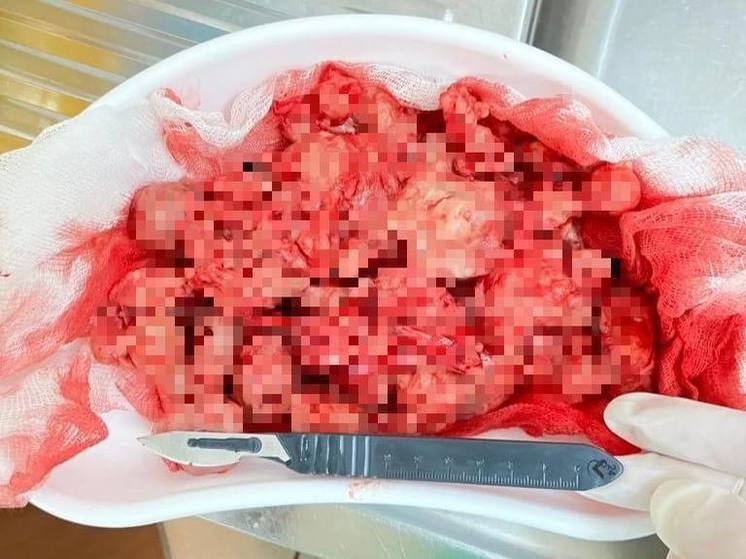 Башкирские хирурги спасли 86-летнего пациента, проведя «операцию отчаяния»