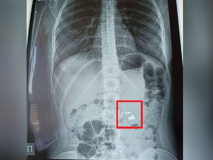 В Уфе 15-летняя девочка проглотила наушник во сне