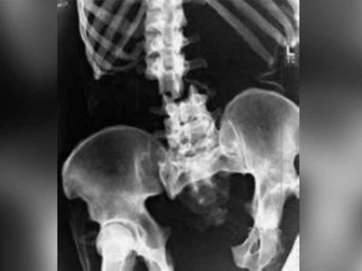 54-летний рабочий сломал позвоночник, упав в кузов машины