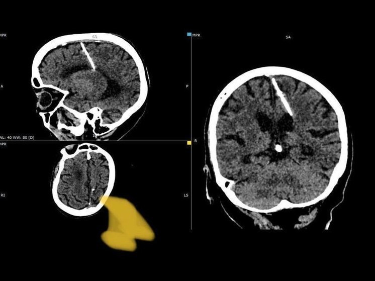 Врачи обнаружили трехсантиметровую иглу в мозгу пожилой жительницы Сахалина