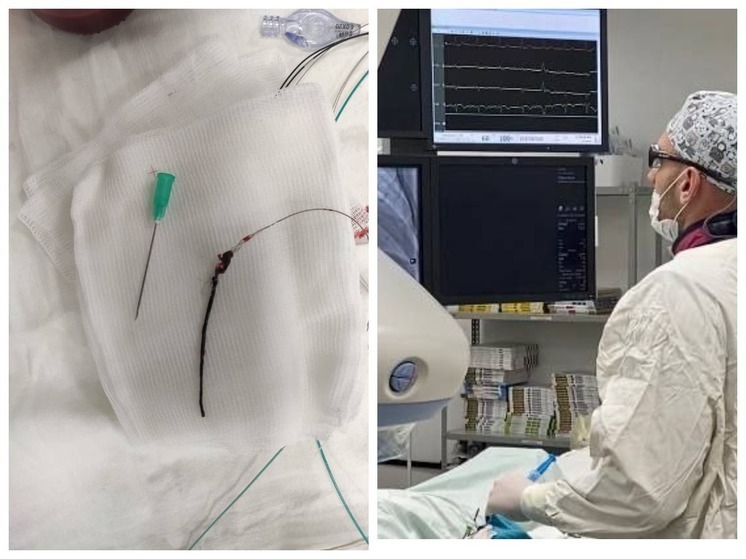 7-сантиметровый тромб извлекли врачи из мозга омича