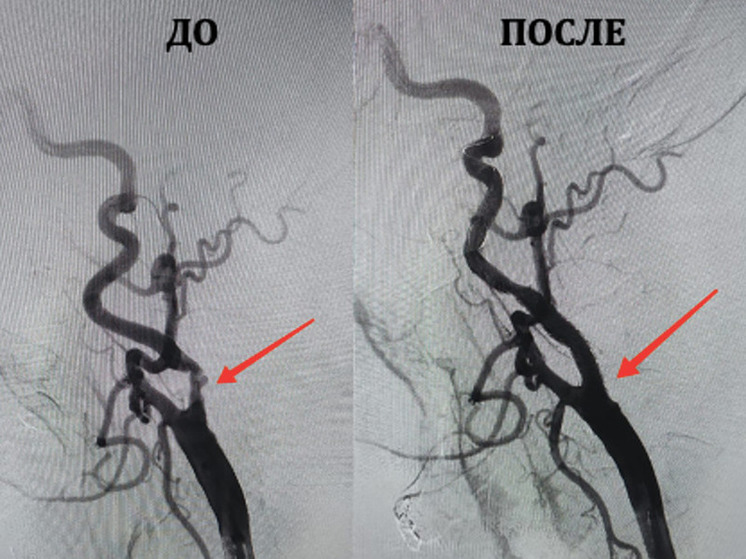 «Пациент избежал инсульта»: мурманские врачи впервые провели стентирование сонных артерий