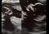 В США 32-летняя жительница Алабамы Келси Хэтчер, родившаяся с очень редким заболеванием, известном как дидельфиз матки (двойная матка) ждет двойню
