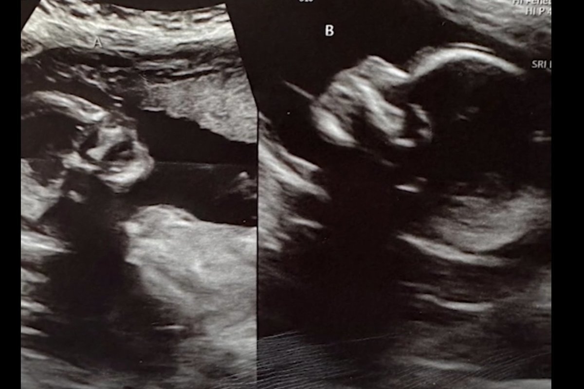 American woman with two uteruses found pregnant in both