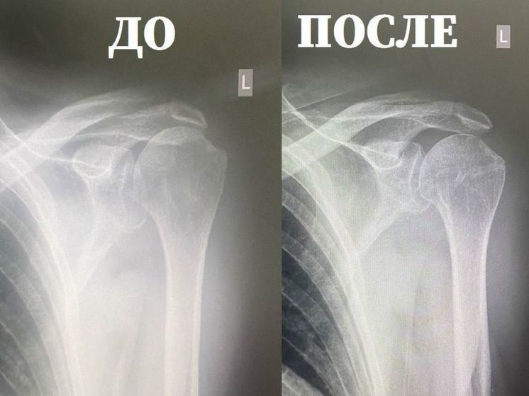 Врачи МОНИКИ освоили новый вид трансплантата плеча