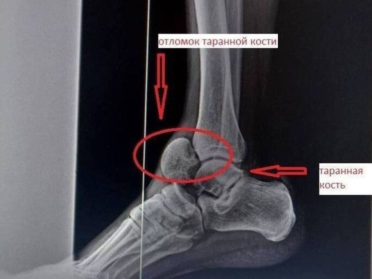 В подмосковной Балашихе врачи вылечили мужчину с редким переломом