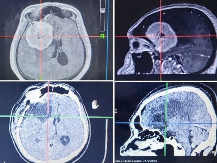 Кузбасские врачи удалили у пациента 6-сантиметровую опухоль головного мозга