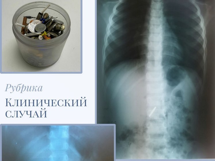 В Балаково двое мальчиков проглотили несъедобные предметы