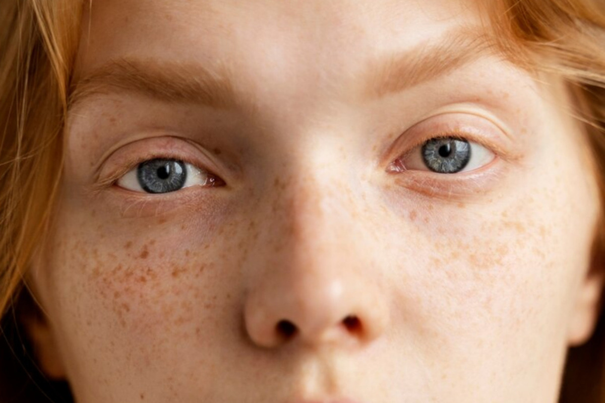 The presence of freckles has been linked to genetics and some secrets of the body