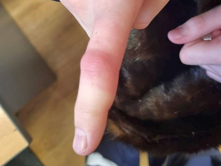 В Башкирии спасатели сняли с пальца подростка кольцо