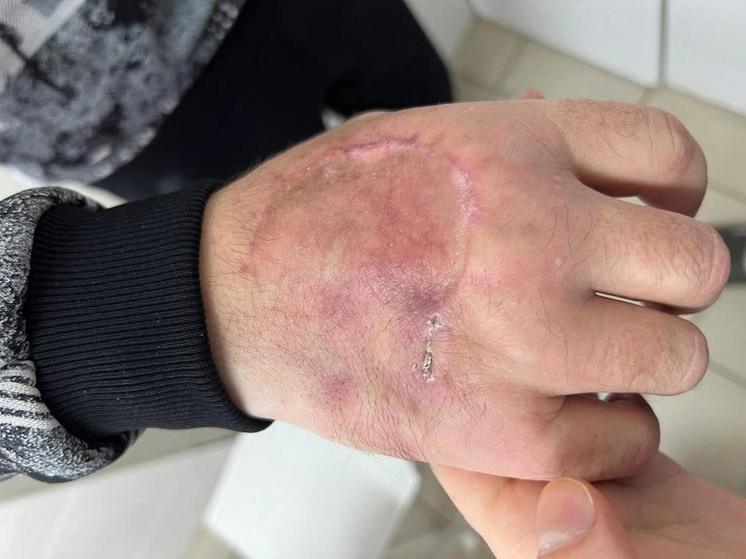 Житель Саратова за несколько минут избавился от опухоли, которую носил 15 лет